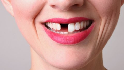 Rüyada Diş Kırılması Ve Rüyada Diş Dökülmesi Rüyada Diş Çekmek